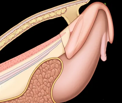 Illustration uncircumcised