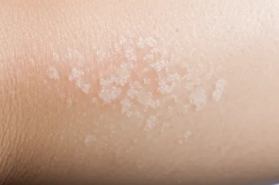 Illustration keratoses