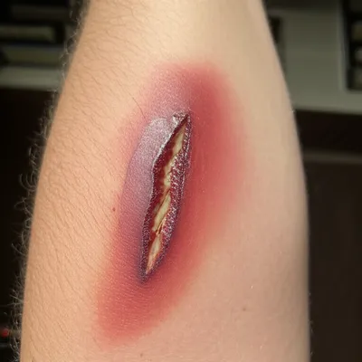 injury
