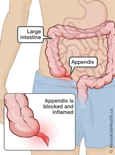 Illustration appendicitis - Image 2
