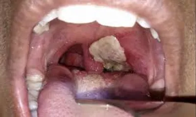 Hình ảnh minh họa diphtheria - Ảnh 2