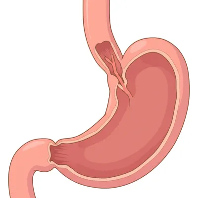 Illustration atresia - Image 1