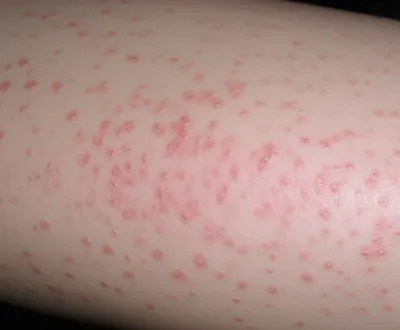 Illustration varioloid - Image 1