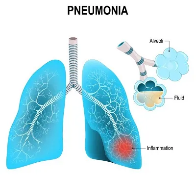Illustration pneumonia - Image 2