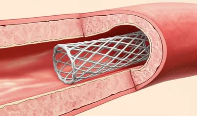 Illustration stents - Image 1
