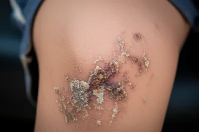 Illustration scabbed - Image 1