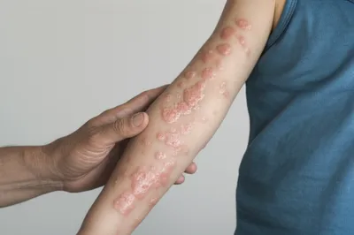 Illustration variola