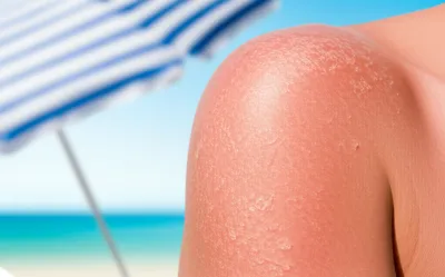 Illustration sunburns