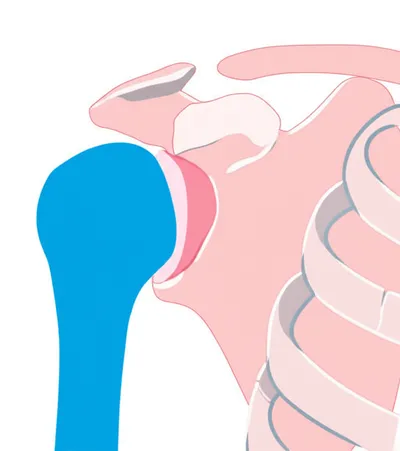 Illustration dislocating - Image 1