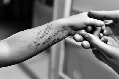 Illustration smallpox