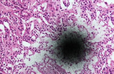 Illustration infiltrate