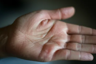 Illustration blistered - Image 1