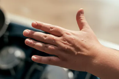 Illustration blistered - Image 1