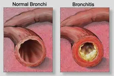 Illustration phlegm - Image 2