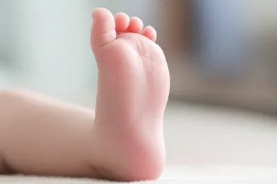 Illustration talipes - Image 1