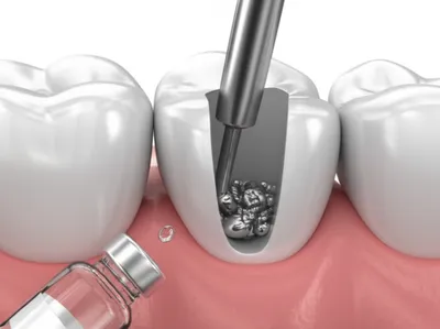 Illustration amalgams - Image 1