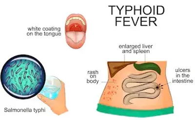 Illustration typhoid - Image 2