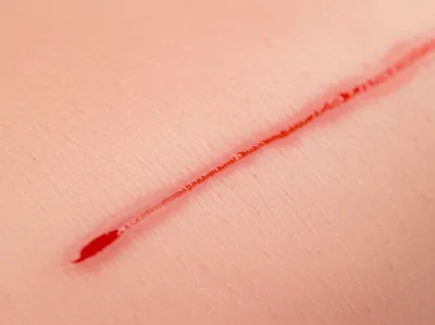 Illustration wound - Image 1