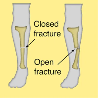 Illustration fracture - Image 3
