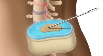Illustration epidural - Image 1