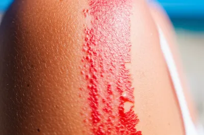 Illustration sunburn