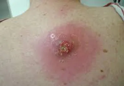 Illustration abscess - Image 2