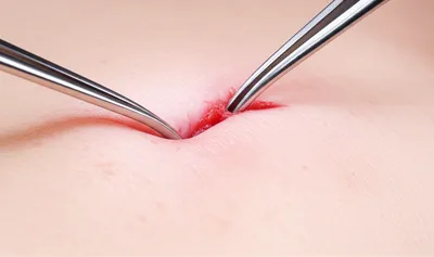 Illustration retractor - Image 1