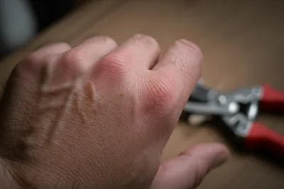 Illustration callosities