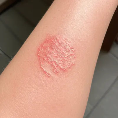 Illustration tetter - Image 1