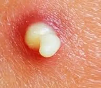 Illustration pus - Image 2