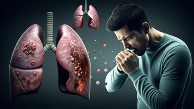 Illustration tuberculosis