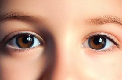 Illustration strabismus