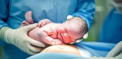 Illustration caesarean - Image 1