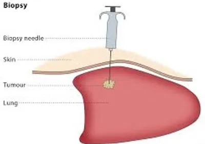 Illustration biopsy - Image 2