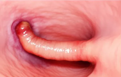 Illustration appendicitis