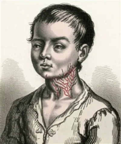 Illustration struma - Image 1