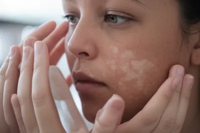 Illustration leprosy