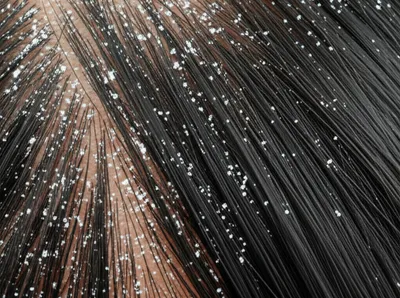 Illustration dandruff - Image 1