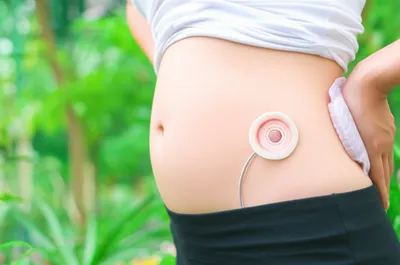 Illustration stoma - Image 1