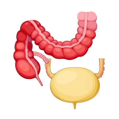 Illustration fistula - Image 1