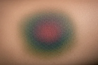 Illustration bruises - Image 1