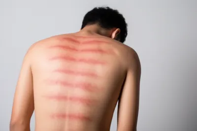 Illustration welts - Image 1