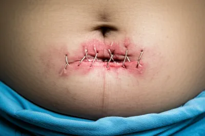 Illustration dehisce - Image 1