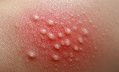 Illustration herpes - Image 1