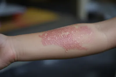 Illustration scald - Image 1