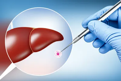 Illustration biopsy - Image 1