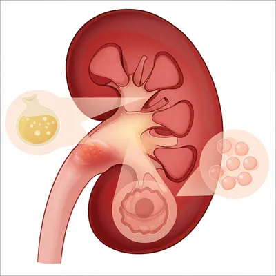 Illustration tumours - Image 1