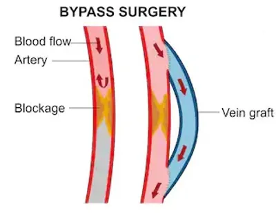 Illustration bypass - Image 2