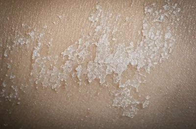 Illustration hyperkeratosis