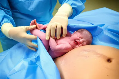 Illustration breech - Image 1